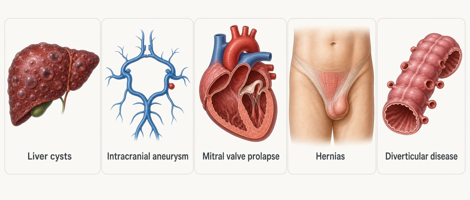 Extrarenal manifestations of ADPKD: liver cysts, intracranial aneurysm, mitral valve prolapse, hernias and diverticular disease