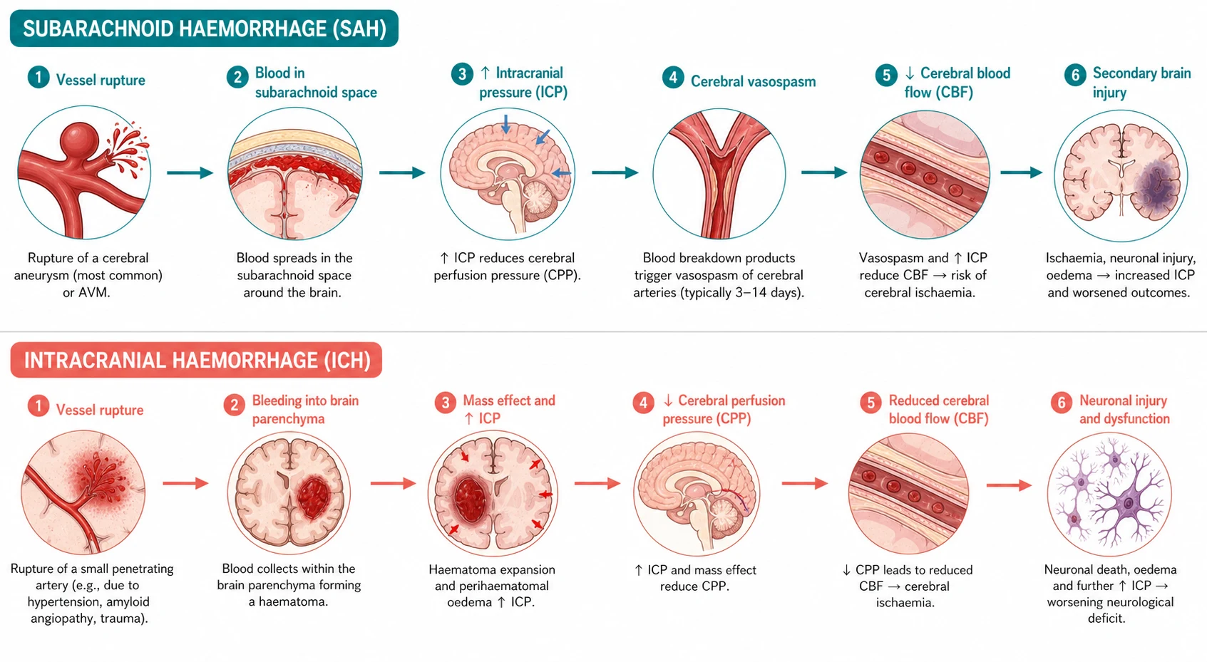 Pathophysiology mechanism diagram for Subarachnoid Haemorrhage AND Intracranial Haemorrhage.