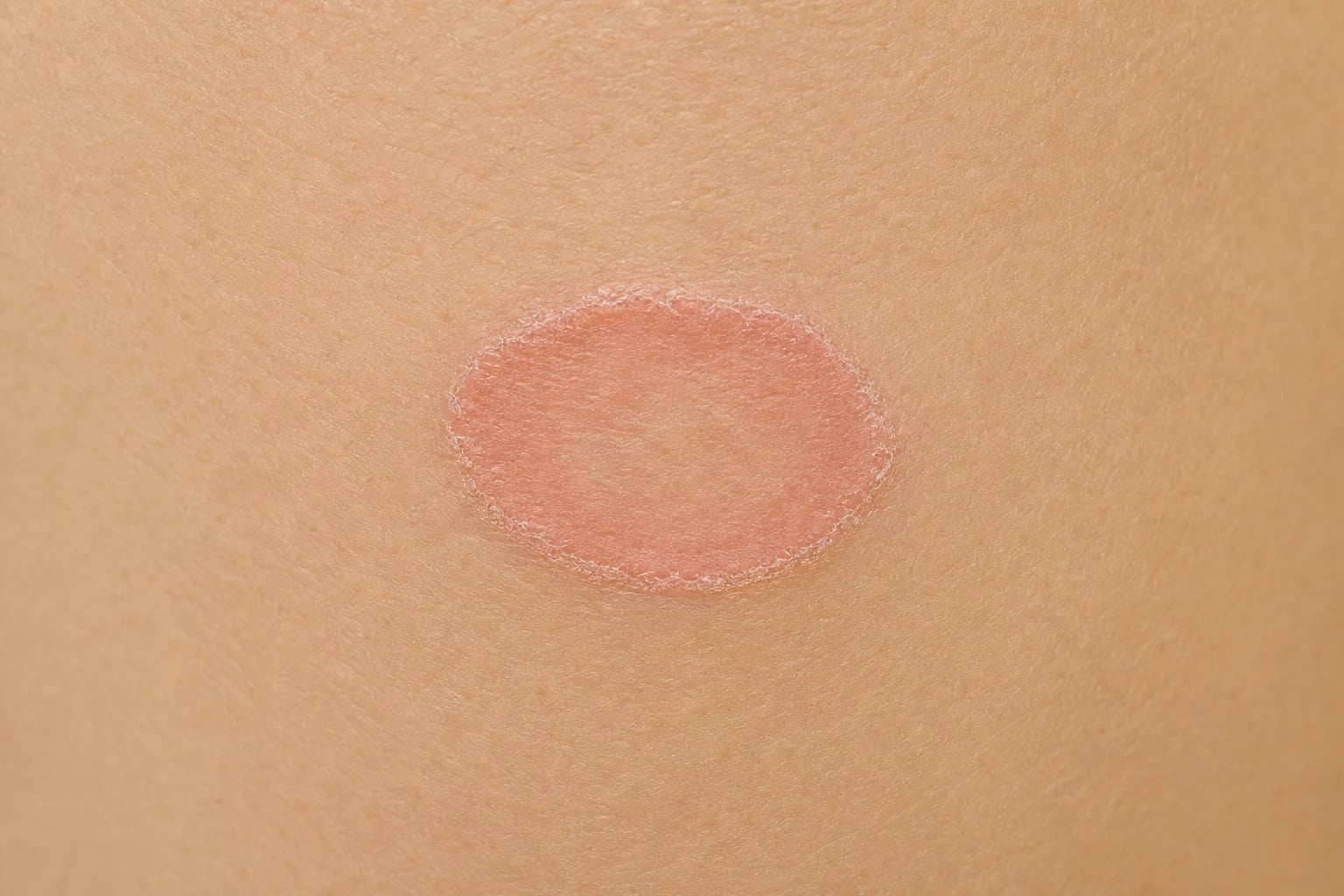 Single oval herald patch with peripheral collarette scale on the trunk