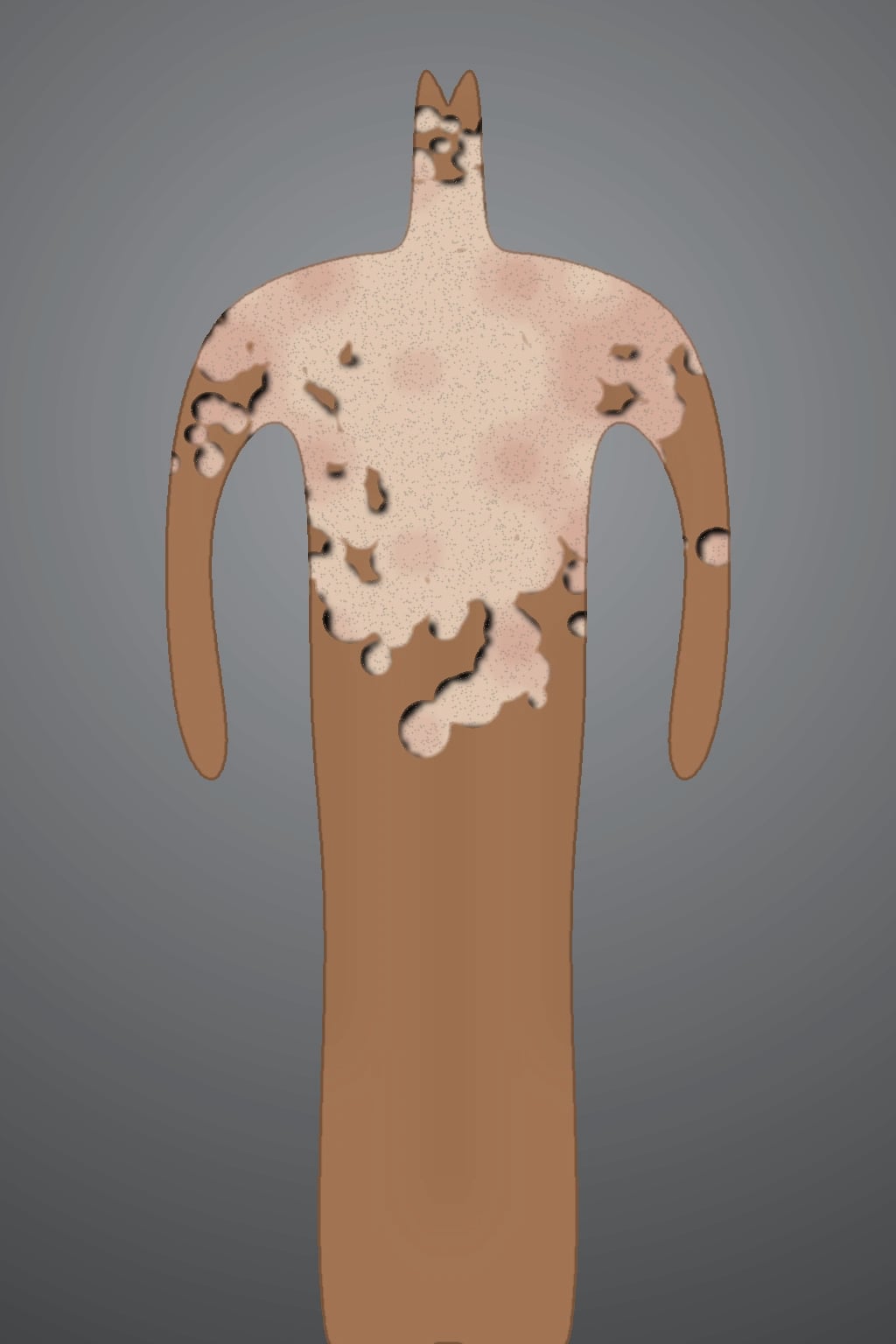 Multiple coalescing hypopigmented and faintly erythematous scaly macules on the upper trunk and shoulders